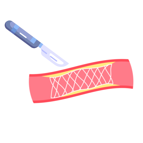 Entre el Bisturí y el Stent